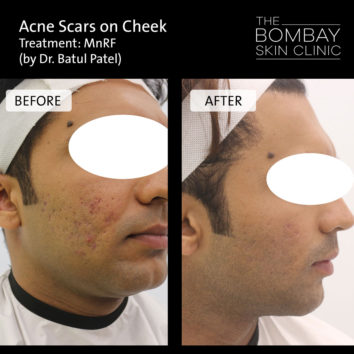 Before After Treatment Skin & Hair Treatment Photos | Dr. Batul Patel